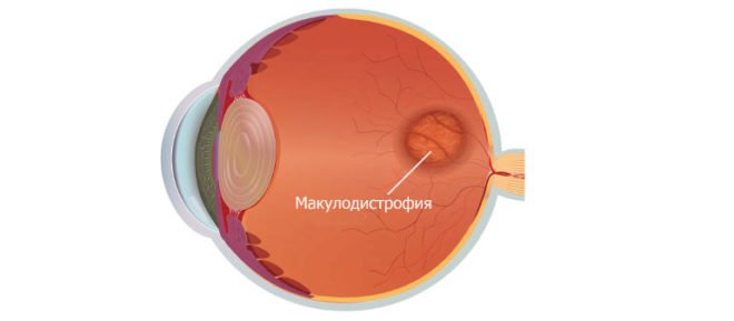 Макулодистрофия сетчатки глаза