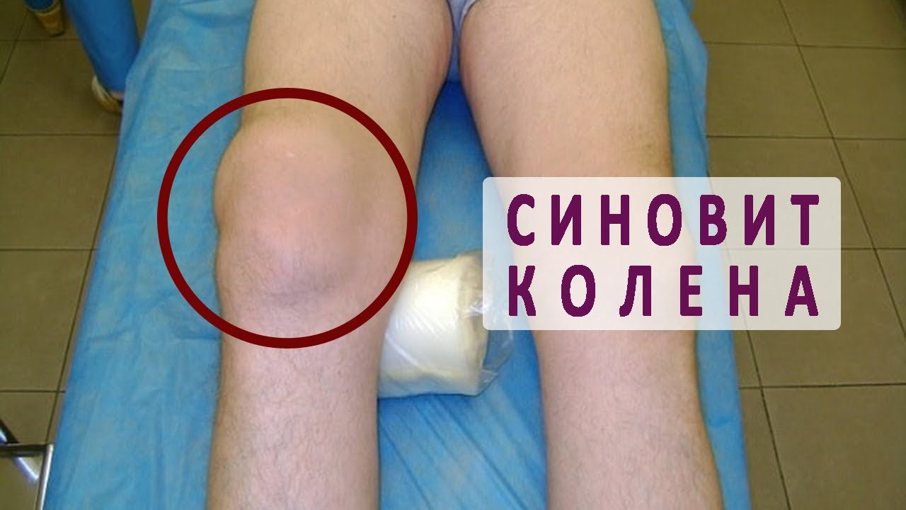 Что такое синовит колена?