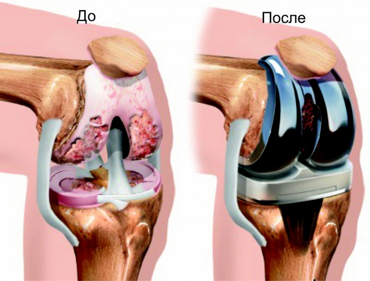 Эндопротезирование коленного сустава при артрозе 3 степени