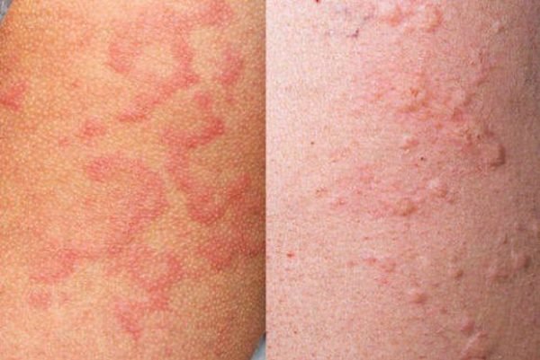 Высыпания на коже при аллергии