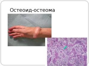 Остеоид остеома