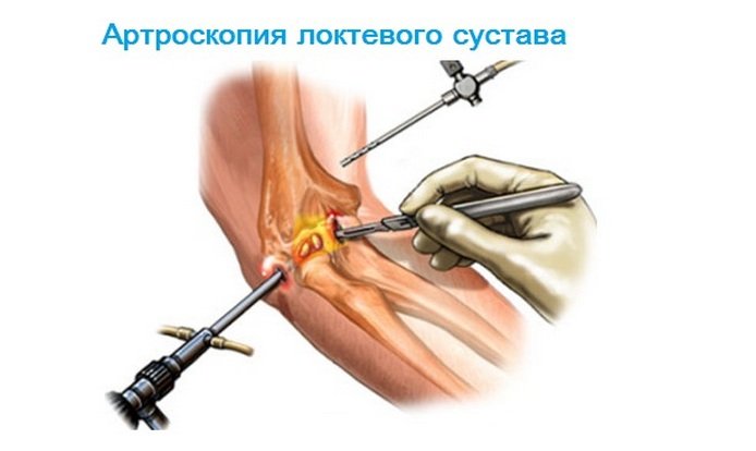 Артроскопия