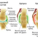 Артриты и артрозы