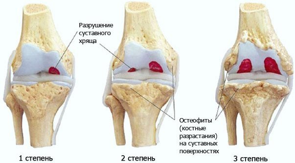 Артроз коленного сустава
