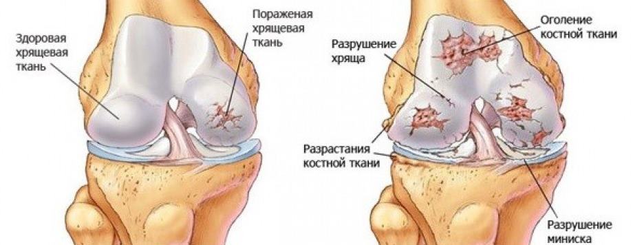 Артроз коленных суставов