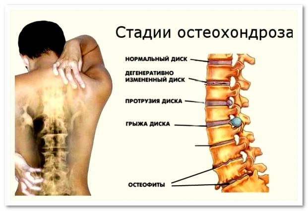 Как развивается остеохондроз