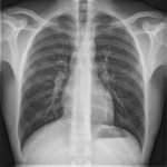 Рентгенография грудной клетки и позвоночника