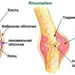 Ревматические болезни