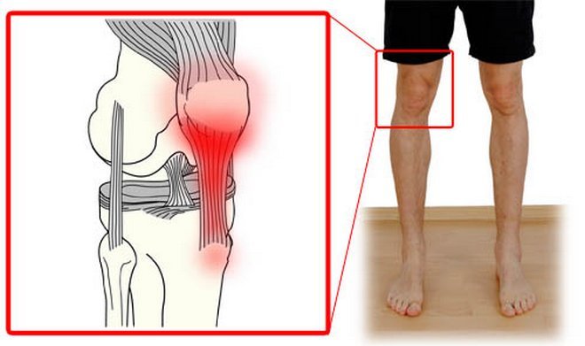 Воспаление сухожилий вокруг коленного сустава 