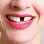 Выпадение зубов из-за потери их устойчивости