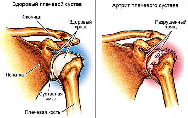 Причины и лечение артрита плечевого сустава
