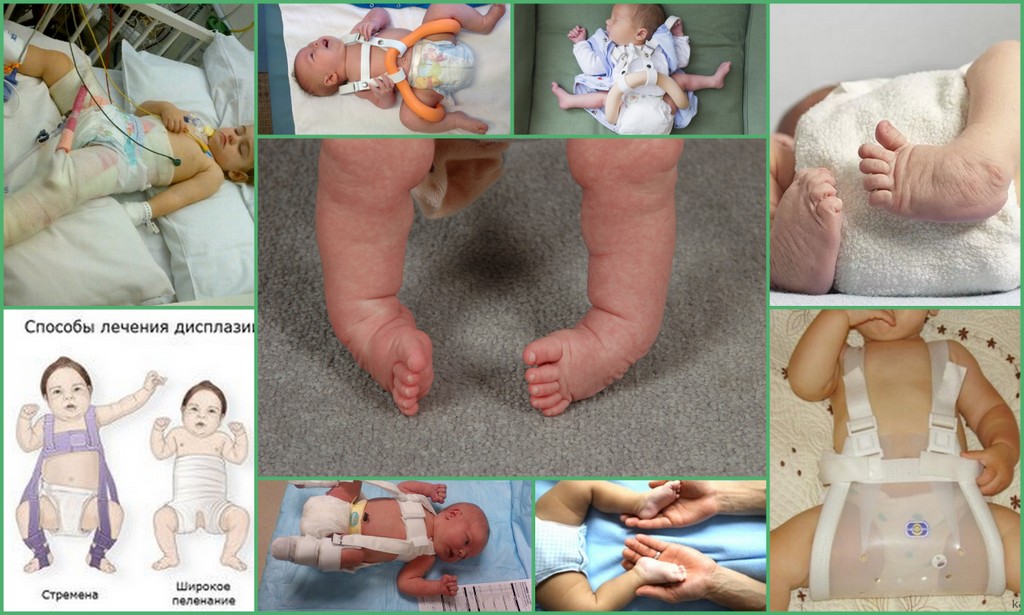 Дисплазия тазобедренных суставов у детей 3 месяца фото