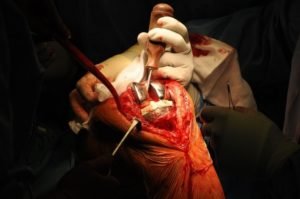 Операция по эндопротезированию коленного сустава при артрозе 3 степени