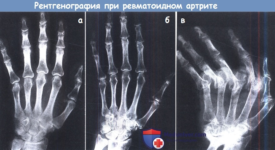 Рентген ревматоидного артрита 