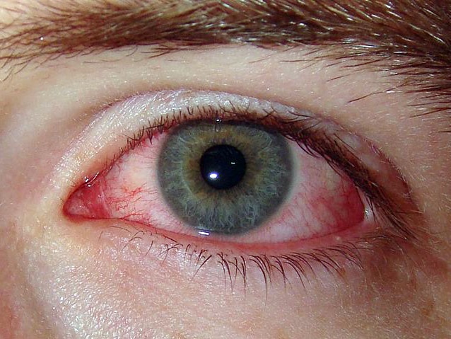 Гиперемия конъюнктивы глаза