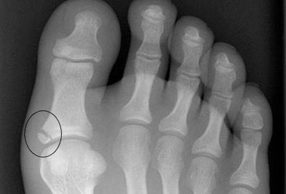 Перелом большого пальца ноги
