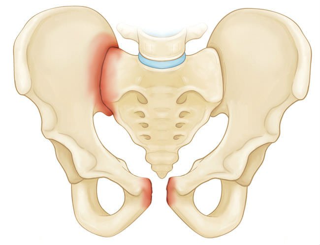 Типы переломов седалищной кости