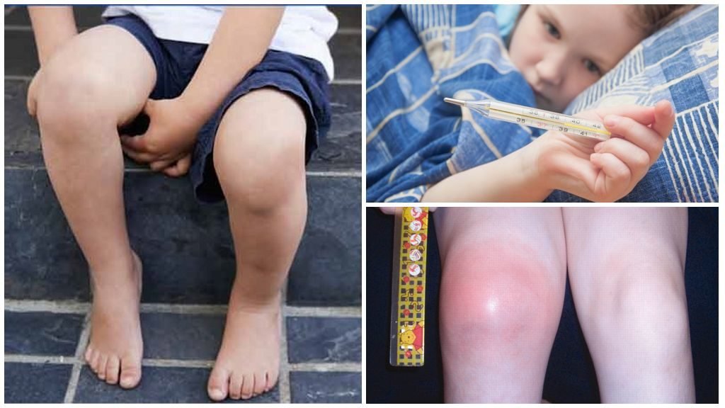 Артрит коленного сустава у детей