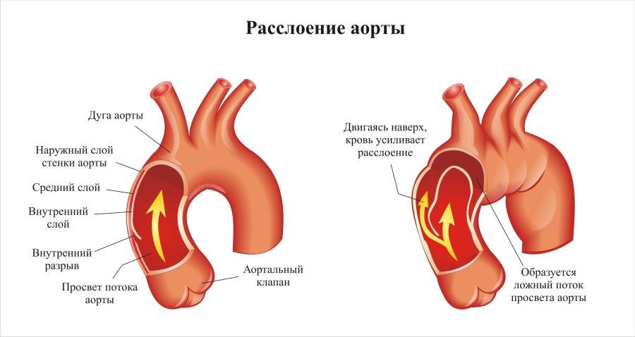 Расслоение аорты человека
