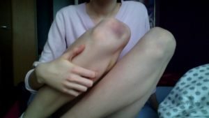 Если в районе колена посинела кожа - следует немедленно обратиться к врачу