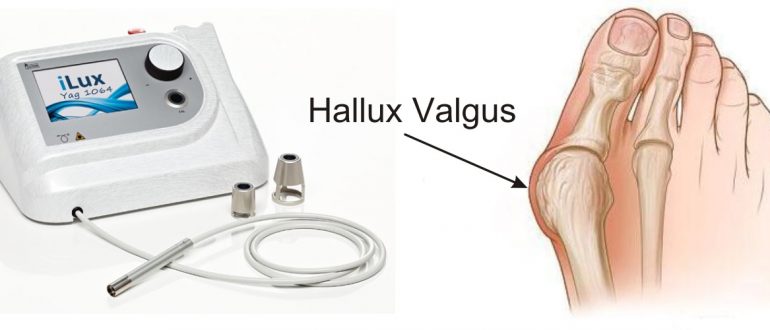Лазер для лечения Hallux valgus 